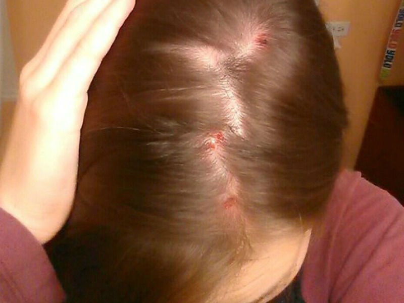3 Natural Remedies To Treat Scalp Pimples Faiza Beauty Cream