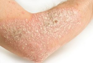 treat psoriasis